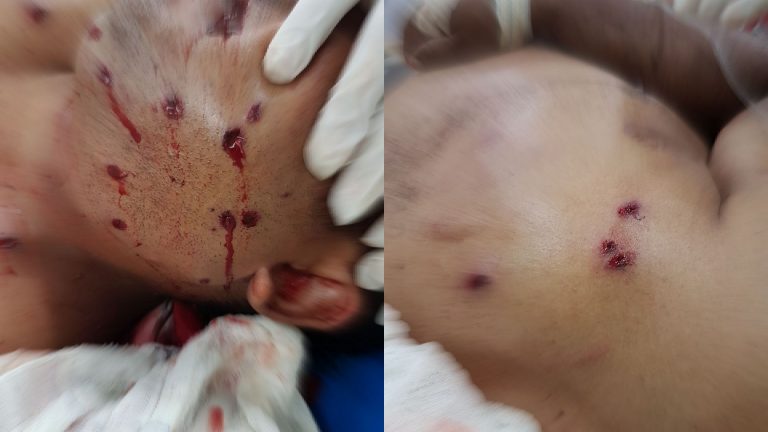 TARAUACÁ: HOMEM É ALVEJADO COM TIRO DE ESCOPETA NO ROSTO