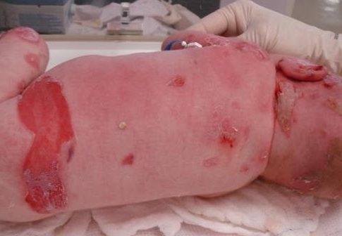 Epidermólise Bolhosa-rara-doença-patologia-causa-diagnóstico-tratamento-prognóstico-sinais-sintomas-malformação-congénita-hereditariedade-autossómica-recessiva-dominante-genética