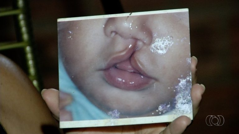 Em três dias, mutirão vai fazer 14 cirurgias de correção de lábio leporino em Cruzeiro do Sul