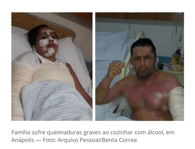 No governo  Bolsonaro: sem gás  , família  usa álcool  para cozinhar  e se queimam