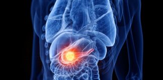 cancer-de-pancreas:-os-sinais-que-seu-corpo-da-e-merecem-atencao