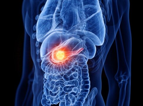 cancer-de-pancreas:-os-sinais-que-seu-corpo-da-e-merecem-atencao