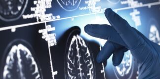 paciente-mais-jovem-com-alzheimer-teve-sinais-aos-17-anos.-saiba-quais