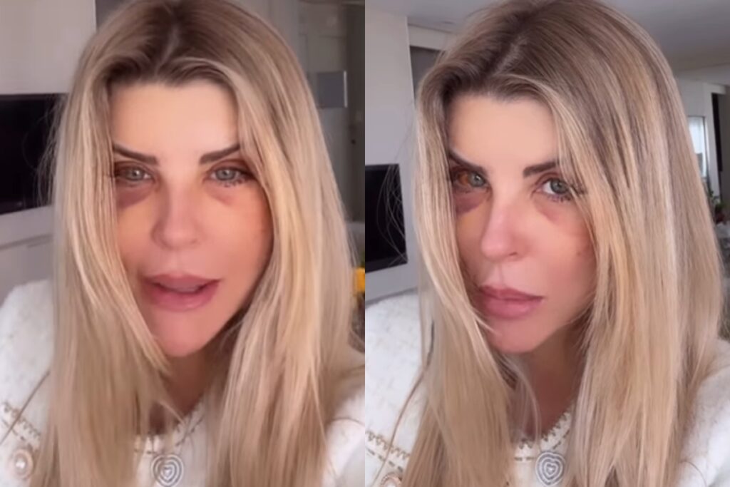 iris-stefanelli-causa-comocao-ao-surgir-com-os-olhos-roxos:-“bateram?”