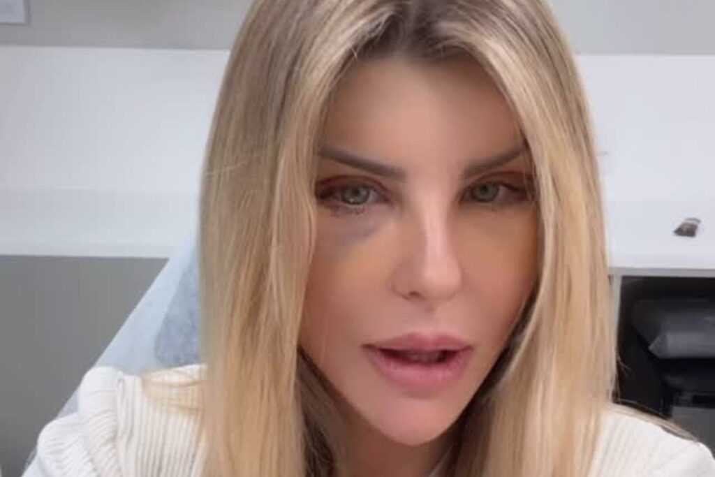 medico-explica-hematomas-nos-olhos-de-iris-stefanelli-apos-cirurgia