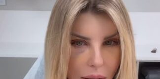 medico-explica-hematomas-nos-olhos-de-iris-stefanelli-apos-cirurgia