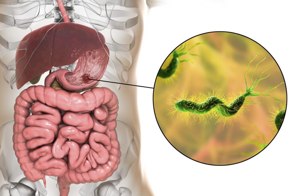 medico-aponta-cha-anti-inflamatorio-que-ajuda-a-combater-a-h.-pylori
