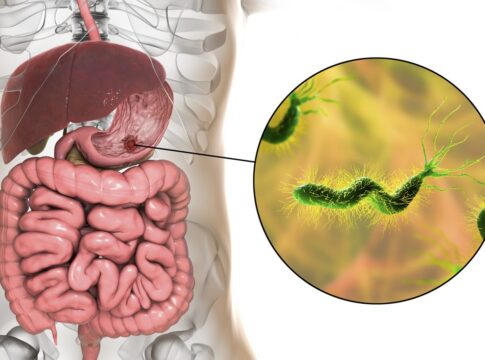 medico-aponta-cha-anti-inflamatorio-que-ajuda-a-combater-a-h.-pylori