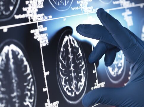 alzheimer:-estudo-brasileiro-acha-marcador-para-acelerar-o-diagnostico