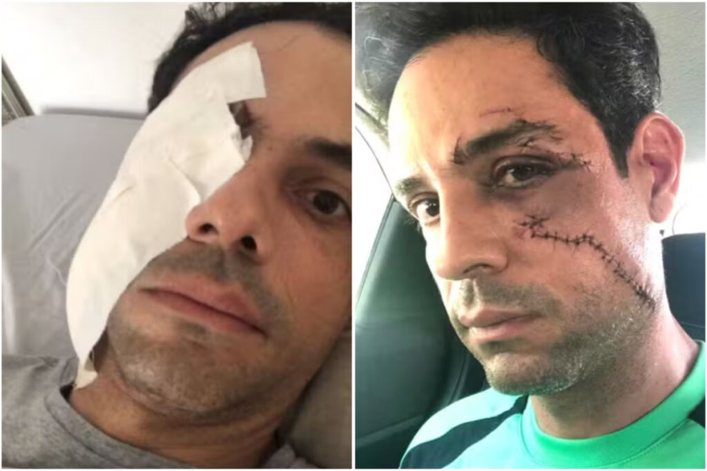 empresario-e-agredido-com-copo-de-vidro-e-leva-62-pontos-no-rosto