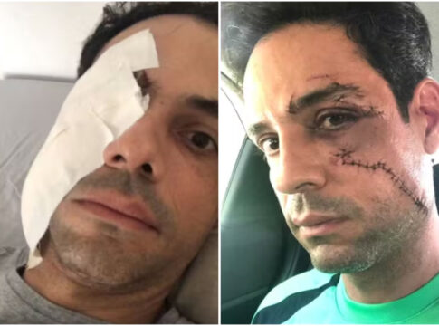 empresario-e-agredido-com-copo-de-vidro-e-leva-62-pontos-no-rosto