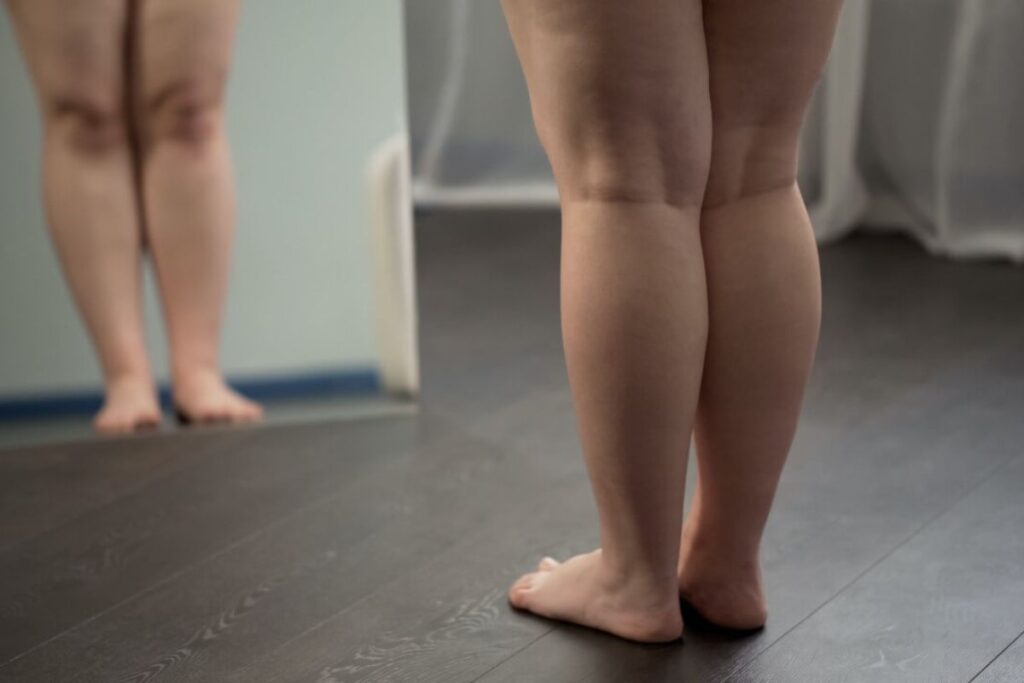 nutricionista-indica-3-dietas-que-auxiliam-no-tratamento-do-lipedema