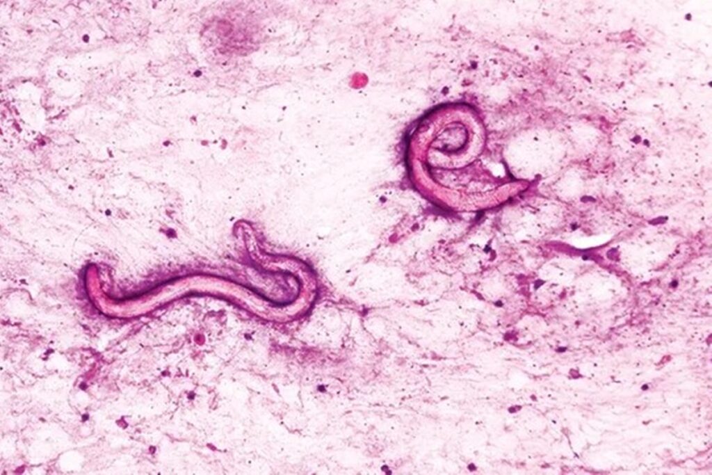 homens-sao-infectados-com-parasitas-apos-transplante-de-rim-nos-eua