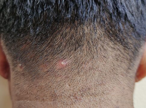 acne-no-couro-cabeludo:-especialista-explica-como-tratar-a-condicao