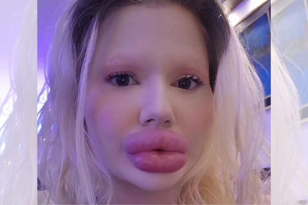 dentistas-se-recusam-a-atender-“mulher-com-maiores-labios-do-mundo”
