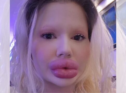 dentistas-se-recusam-a-atender-“mulher-com-maiores-labios-do-mundo”