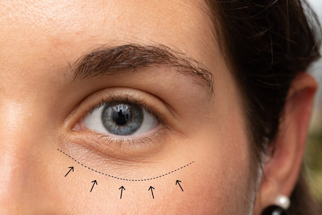 confira-seis-passos-para-suavizar-as-bolsas-nos-olhos-naturalmente