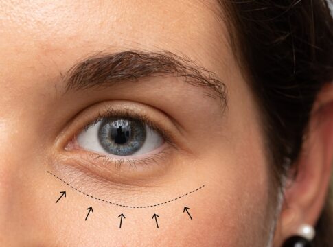 confira-seis-passos-para-suavizar-as-bolsas-nos-olhos-naturalmente