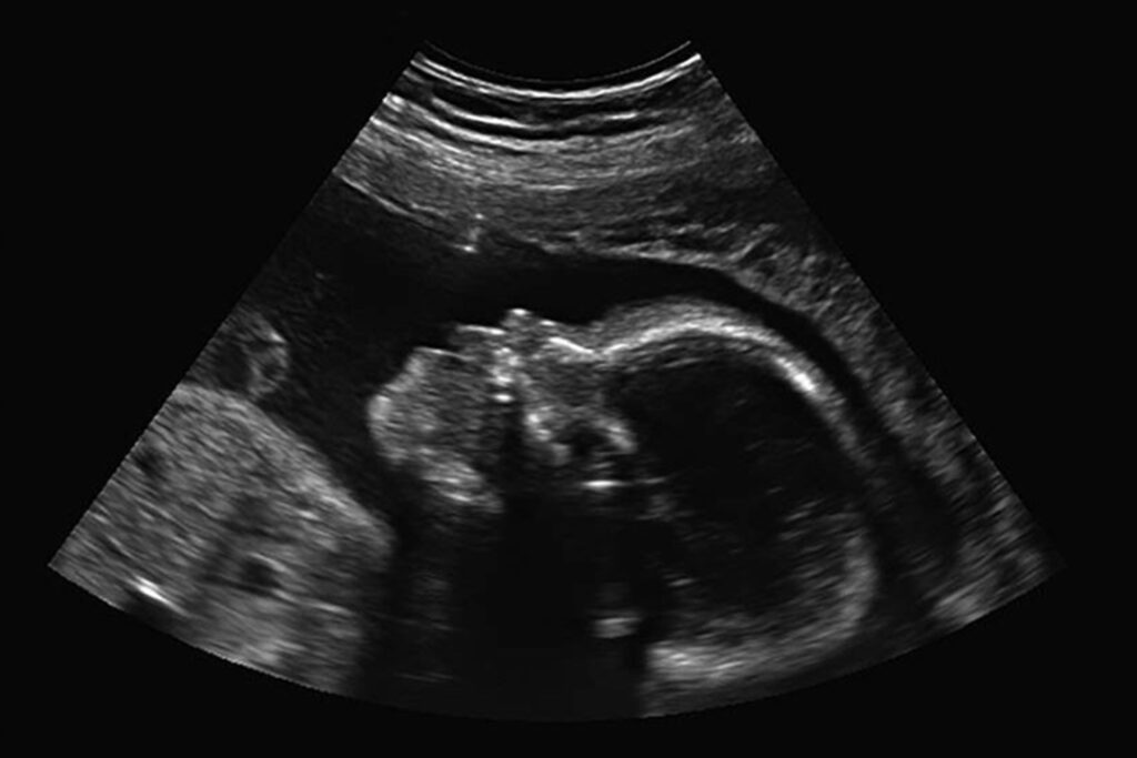 df:-adolescente-asfixia-e-joga-bebe-prematuro-no-lixo-ao-forcar-aborto