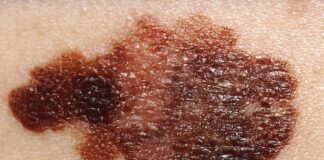 virus-da-herpes-modificado-reduz-melanoma-avancado-em-ensaio-clinico