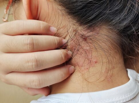 alimentacao-pode-influenciar-sintomas-da-psoriase,-aponta-estudo