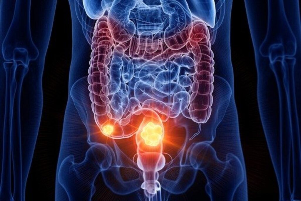 quando-a-comocao-vira-alerta:-por-que-o-cancer-colorretal-atinge-cada-vez-mais-jovens