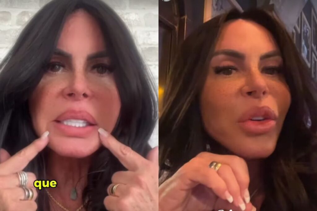 gretchen-remove-pmma-dos-labios:-“agora-esta-perfeita”