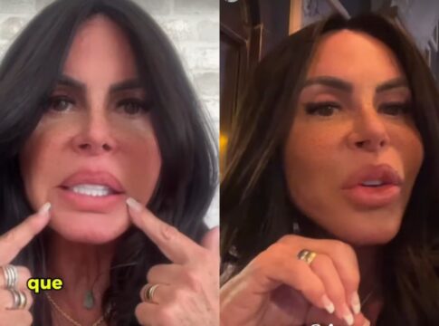 gretchen-remove-pmma-dos-labios:-“agora-esta-perfeita”