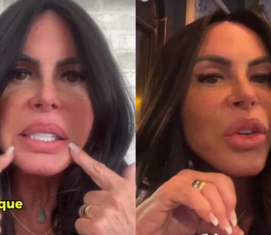 gretchen-remove-pmma-dos-labios:-“agora-esta-perfeita”