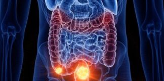 cancer-de-intestino:-saiba-como-e-feita-e-quando-comecar-a-prevencao