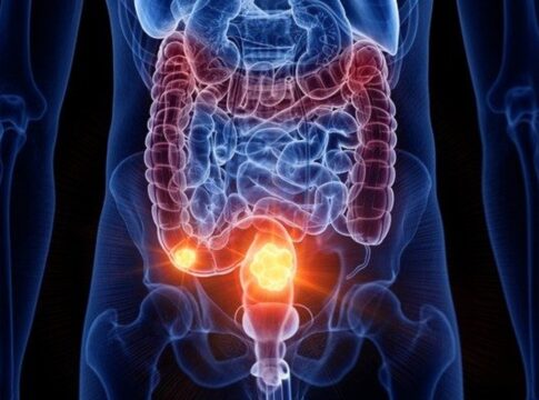 cancer-de-intestino:-saiba-como-e-feita-e-quando-comecar-a-prevencao