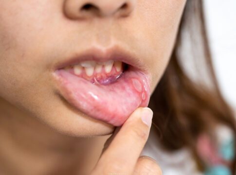 saiba-como-tratar-aftas-de-forma-caseira-e-quando-procurar-o-dentista