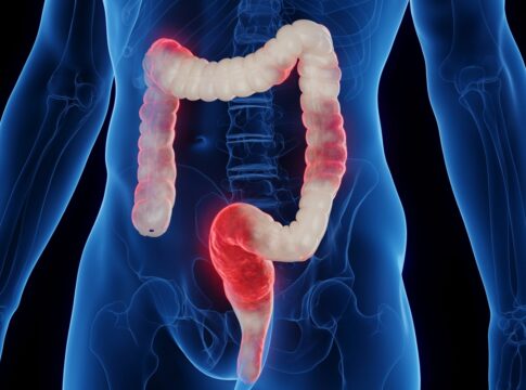 veja-3-alimentos-anti-inflamatorios-que-auxiliam-na-limpeza-do-colon