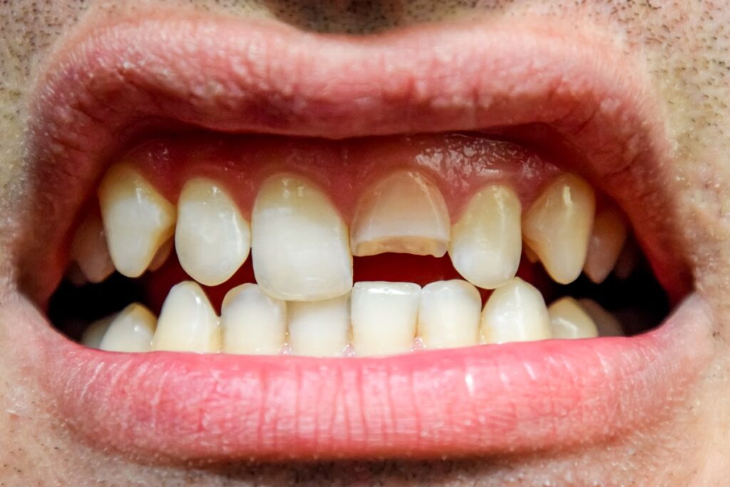 quebrou-o-dente?-especialista-explica-como-agir-nessa-situacao