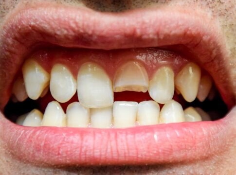 quebrou-o-dente?-especialista-explica-como-agir-nessa-situacao