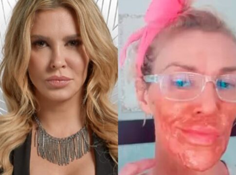 ex-modelo-tem-queimaduras-ao-tentar-matar-parasita-no-rosto.-entenda
