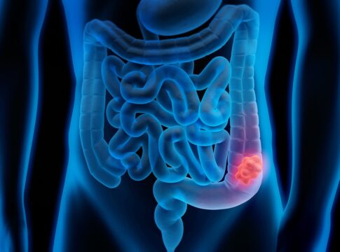 mortes-por-cancer-colorretal-devem-crescer-36%-ate-2040,-diz-estudo