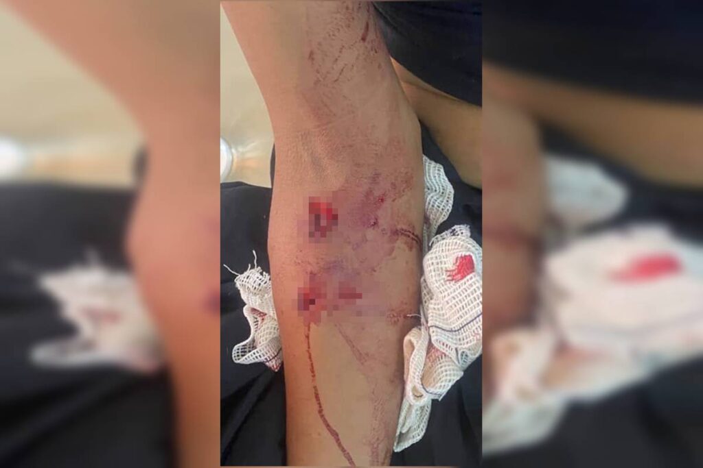 imagens-fortes:-veja-lesoes-de-mulher-atacada-por-seis-caes-de-rua