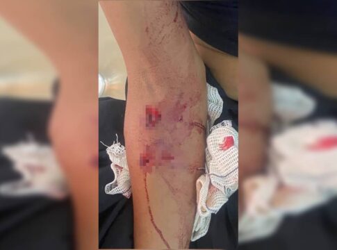 imagens-fortes:-veja-lesoes-de-mulher-atacada-por-seis-caes-de-rua