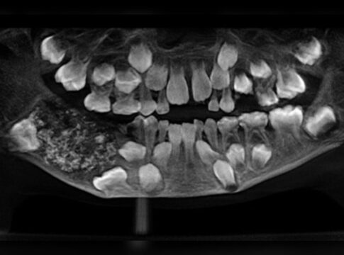 menino-de-7-anos-tem-526-dentes-retirados-em-cirurgia-na-india