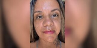 mulher-agredida-com-61-socos-mostra-resultado-de-reconstrucao-facial