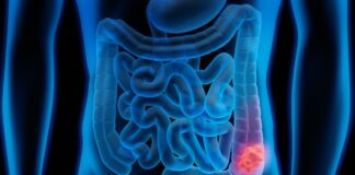 medicos-apontam-6-medidas-para-reduzir-risco-de-cancer-de-intestino