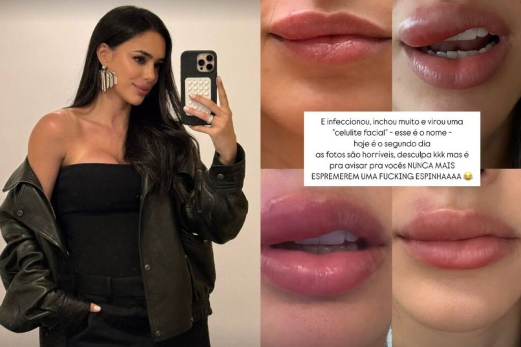 o-que-e-celulite-facial,-grave-infeccao-revelada-por-bruna-biancardi