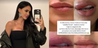 o-que-e-celulite-facial,-grave-infeccao-revelada-por-bruna-biancardi