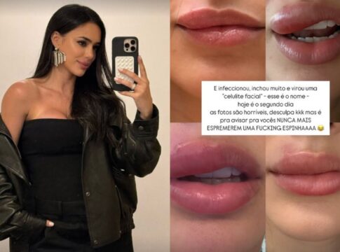 o-que-e-celulite-facial,-grave-infeccao-revelada-por-bruna-biancardi