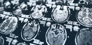 novo-tratamento-para-alzheimer-chega-ao-brasil.-saiba-como-funciona