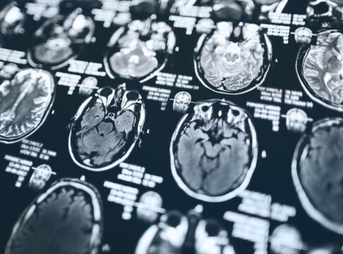 novo-tratamento-para-alzheimer-chega-ao-brasil.-saiba-como-funciona