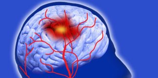 sindrome-de-moyamoya:-conheca-doenca-que-aumenta-riscos-de-avc