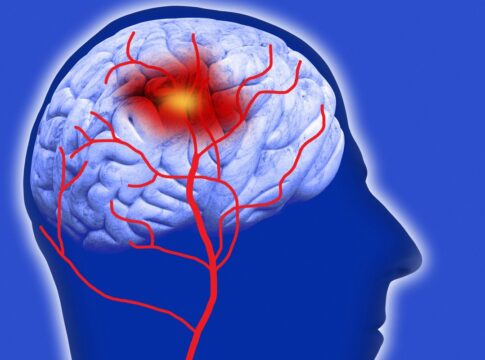 sindrome-de-moyamoya:-conheca-doenca-que-aumenta-riscos-de-avc