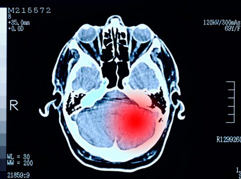 desordem-em-aneis-de-dna-revela-pistas-sobre-cancer-cerebral-agressivo